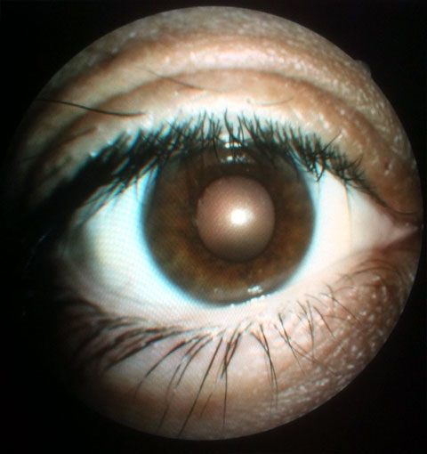 my eyeball