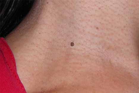 neck mole before